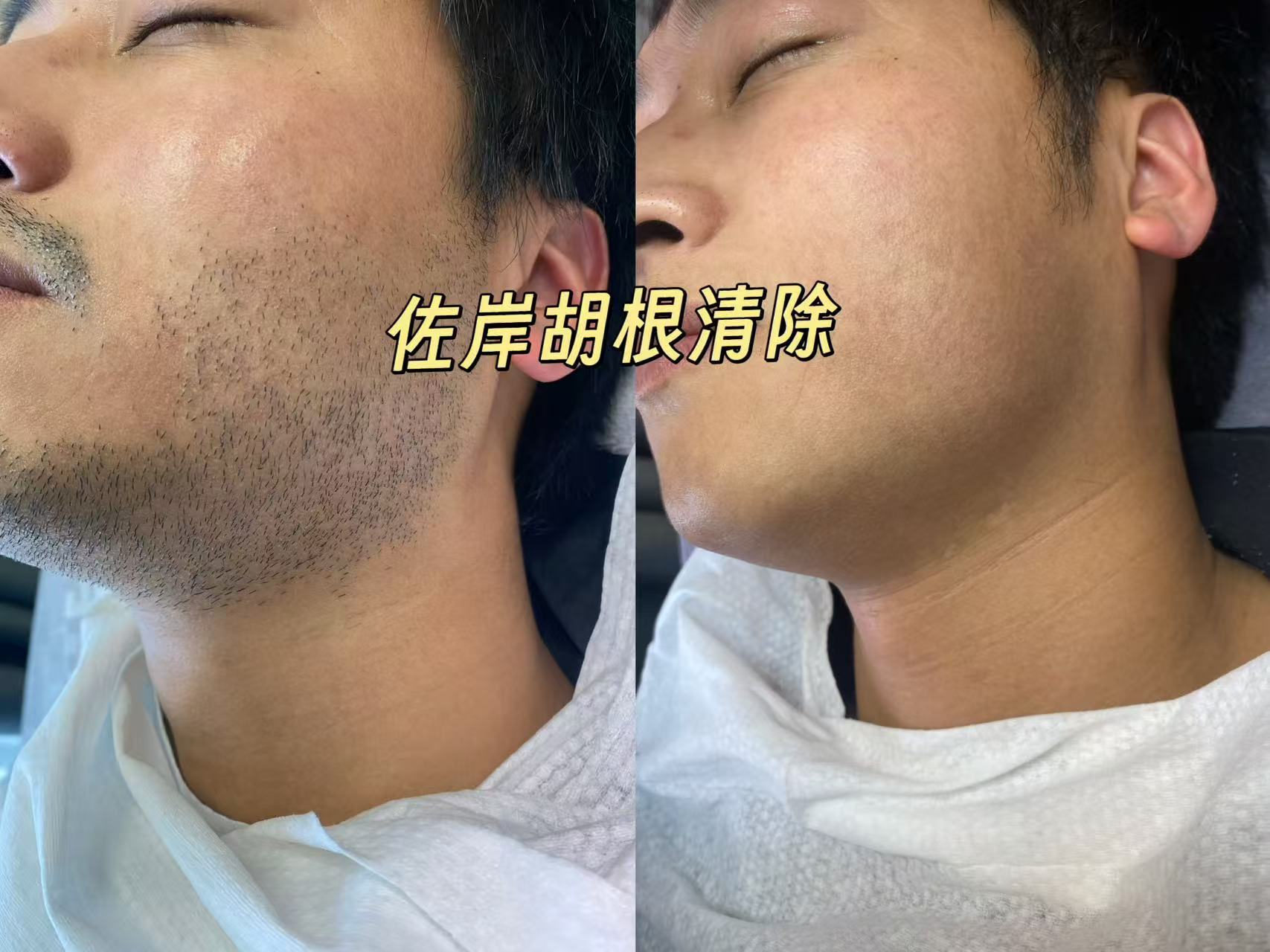 金华脱胡子